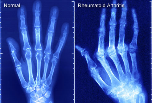 News on Rheumatoid Arthritis by All Deep Massage & Wellness Clinic