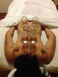 Cupping at All Deep Massage & Wellness Clinic