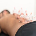 Benefits of Cupping Therapy in Sherwood Park, AB